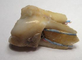 diente endodonciado partido