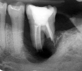 radiograf�a de diente molar endodonciado matado el nervio con gran bolsa de pus