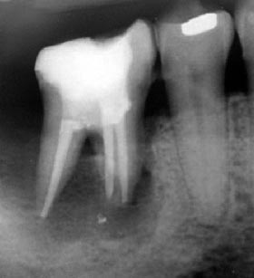 radiograf�a de diente molar endodonciado matado el nervio